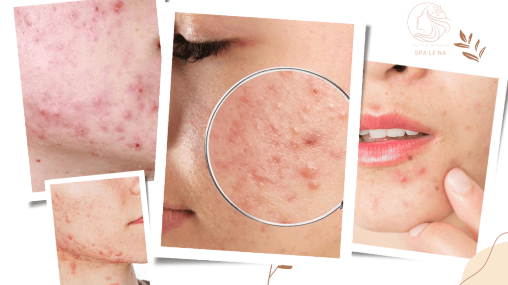 điều trị mụn nội tiết