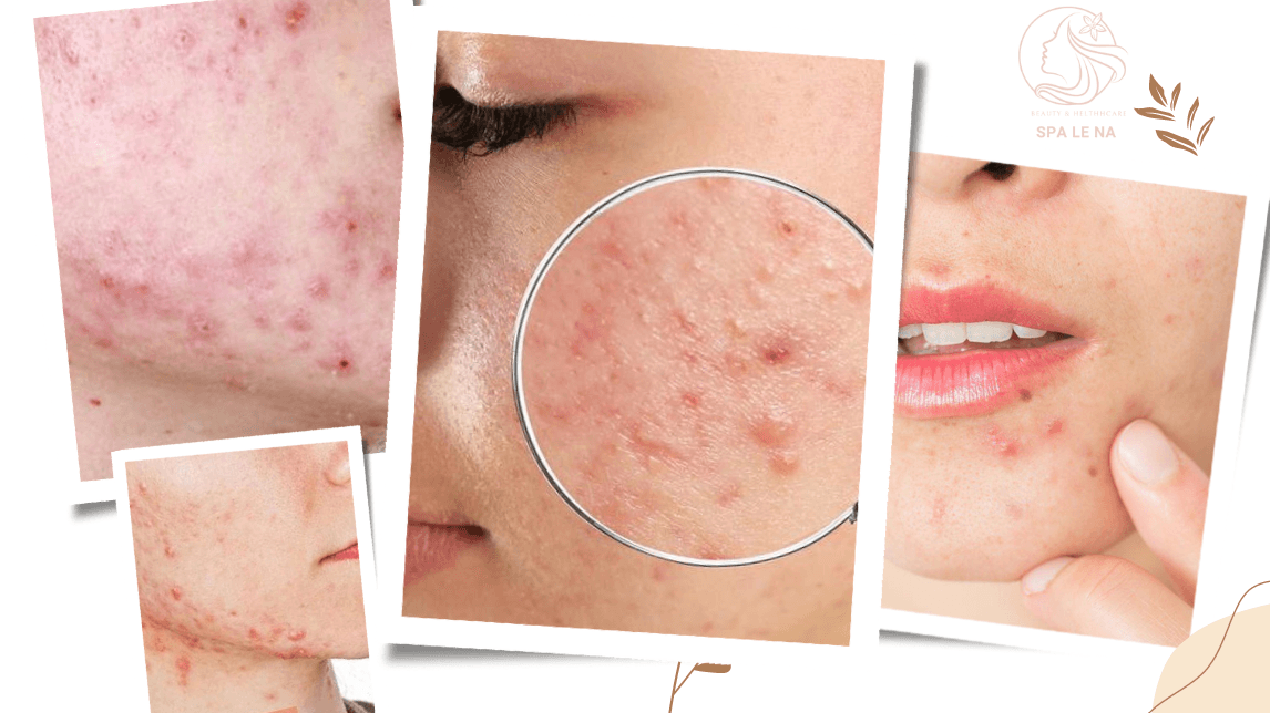 điều trị mụn nội tiết