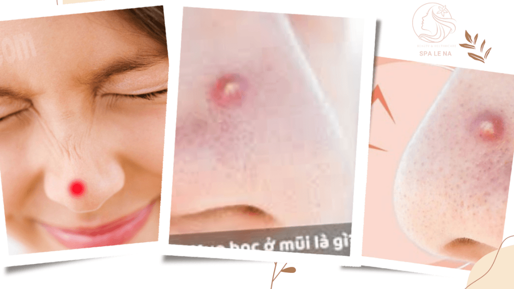 mụn bọc ở mũi